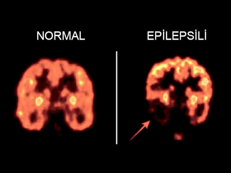 Epilepsi Nedir?